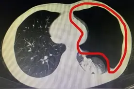 男子排便时太用力，竟把肺憋“炸”了！医生提醒：排便切忌用力过猛，多种风险后果严重→图片