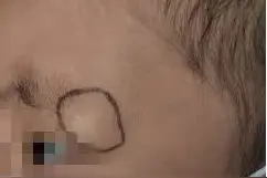 不是“蚊子包” 不是“磕碰包”，孩子眉弓上的小疙瘩到底是个啥？图片