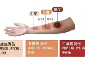 后果很严重！警惕生活中的意外烧烫伤，这些急救误区一定要知道！图片