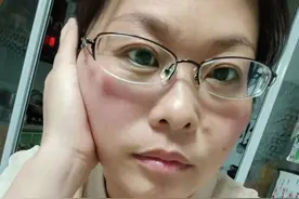 “断崖式衰老”当事人：本以为可以漂亮过完余生！医生详解卵巢早衰图片