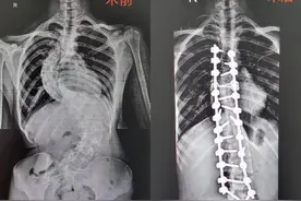 湖南16岁女孩脊柱侧弯获矫正 暑期蜕变身高增六厘米图片
