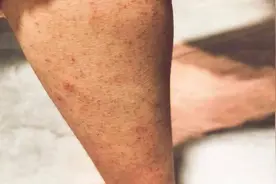 男子穿紧身保暖裤导致腿毛消失，无法忍受37℃温水洗澡图片