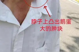 七旬老人误吞鱼刺，脖子上长出鹅蛋大肿块图片