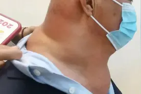 男子身材异常“魁梧”，完全看不到脖子，其实是病！医生割下10斤重脂肪图片