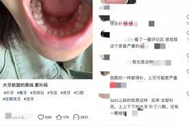 “一补得补8颗！”网友瑟瑟发抖，牙齿出现黑线就要补吗？|网红说法求真图片