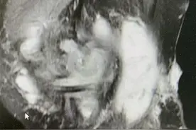 女子膝盖饱受红斑狼疮折磨一度想截肢，专家帮其成功脱拐图片