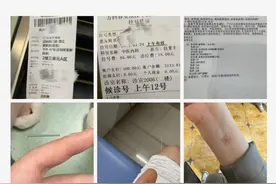 嘴唇干裂、起皮，当心“元凶”不是干燥！可能是唇炎的信号图片