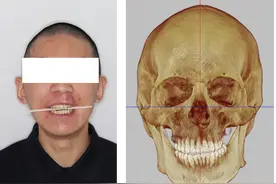 华西口腔医院完成全国首例自主研发3D打印钛板正颌手术图片