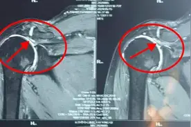 医生巧用大腿筋膜“移花接木”治疗巨大肩袖撕裂图片