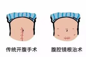 当结肠癌遇到胆总管结石，一台微创手术同时解决两大难题图片