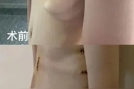 14岁男孩胸前长“翅膀” 竟是“鸡胸+漏斗胸”图片