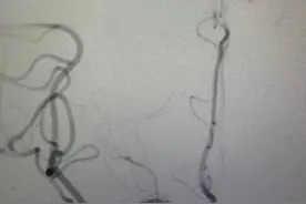 睡梦中脑血管“鼓包”破裂，苏醒后大妈才知“鬼门关走了一遭”图片
