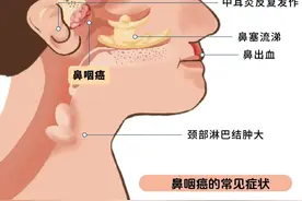 体检新招式：鼻咽癌早期筛查，让你的健康不留死角！图片
