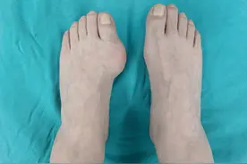 男子脚部长出鸡蛋大小痛风结石 专家提醒：节日期间更要当心饮食图片