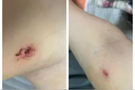 深圳一市民10天内接连被自家狗咬伤， 全市45家犬伤门诊均可处置狂犬病暴露图片