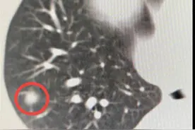最低温至零下160℃，冷冻消融杀死肺结节癌细胞图片