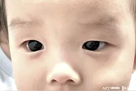 泰国半岁男婴用药治疗新冠，深褐眼睛竟然一夜之间变成亮蓝色图片