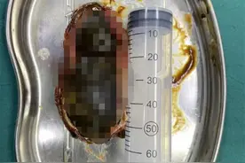 82岁婆婆患胆结石不重视，直到它长到鹅蛋大……图片