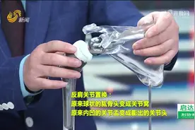 古稀老人“摔一跤”竟致肩部粉碎性骨折！肩关节置换重塑新生图片