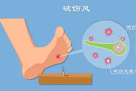 被鸡啄伤险丧命，专家提醒：小伤口也可能致命，预防破伤风至关重要图片