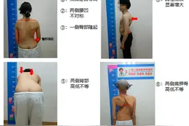 夏季最易发现早期脊柱侧弯 医生支招如何居家检查、尽早干预图片