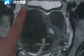 女子爱跟老公生闷气，子宫长出8个肌瘤！最大的比拳头还大图片