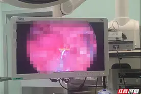 消失的牙签？男子误吞牙签被刺穿回肠，医生消化内镜微创取出图片