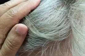 白头发越长越多？可能是缺这3种营养了图片