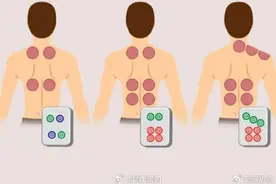 拔火罐吸出的瘀血并非排毒，可能是皮肤受损的表现图片