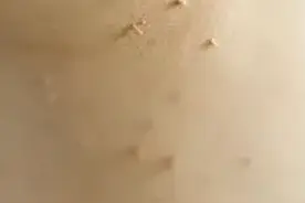 脖子上长了小疙瘩，30岁女子慌了图片