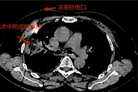用形似牙签的穿刺针传递液氮，零下168℃“冻死”肿瘤细胞图片