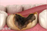 牙齿只有一个小黑点，有必要去医院吗？图片