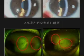 七岁娃突然眼睛发红视力减弱，来青检查后发现原来患有这种病图片
