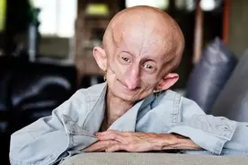 南非最后一位早衰症患者去世 衰老速度是常人8倍图片