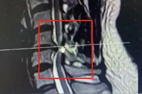 男子按摩时突感全身“过电”！去医院一查，坏了图片