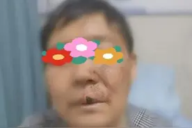 针到痛除！疼痛科微创技术巧解带状疱疹后遗神经痛图片