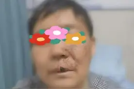 针到痛除！疼痛科微创技术巧解带状疱疹后遗神经痛图片