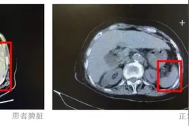 七旬老人脾脏肿大如皮球，少说4斤重，切还是不切？这成了棘手事图片