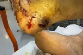 进入高发期！台州一男子被咬一口，肿到青紫！看到请远离图片