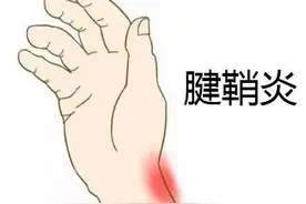 西安市红会医院疼痛科小针刀疗法助患者轻松摆脱腱鞘炎困扰图片