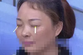 突发！泉州一小伙突然“见不得光”！这病每5人中就有1人得！图片