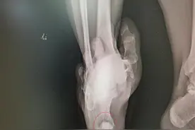 男子被铁钉扎破脚，险些丢了脚后跟图片