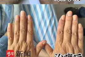淮安六旬大妈“口腔溃疡”不止，原来她患上罕见的“白塞病”图片