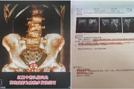 警惕！大爷一晚跑十几次厕所，竟是患上这种病图片