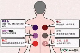松山医院：中医拔罐疗效多 但不要盲目跟风图片