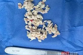 六旬爹爹每天两碗骨头汤，竟让他疼得无法下地！膝盖里发现30多颗痛风石图片