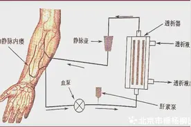 【杨柳科普】找到适合自己的“血流量”，让透析肾友生活更精彩！图片