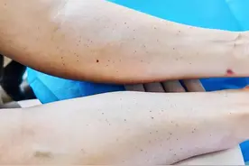 确诊了！女子手臂上都是小红点 密密麻麻……图片