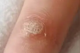 越抠越多！身上长的小疙瘩，或是HPV病毒感染图片