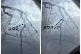 别不当回事！男子牙疼数日，没想到是心肌梗死……图片